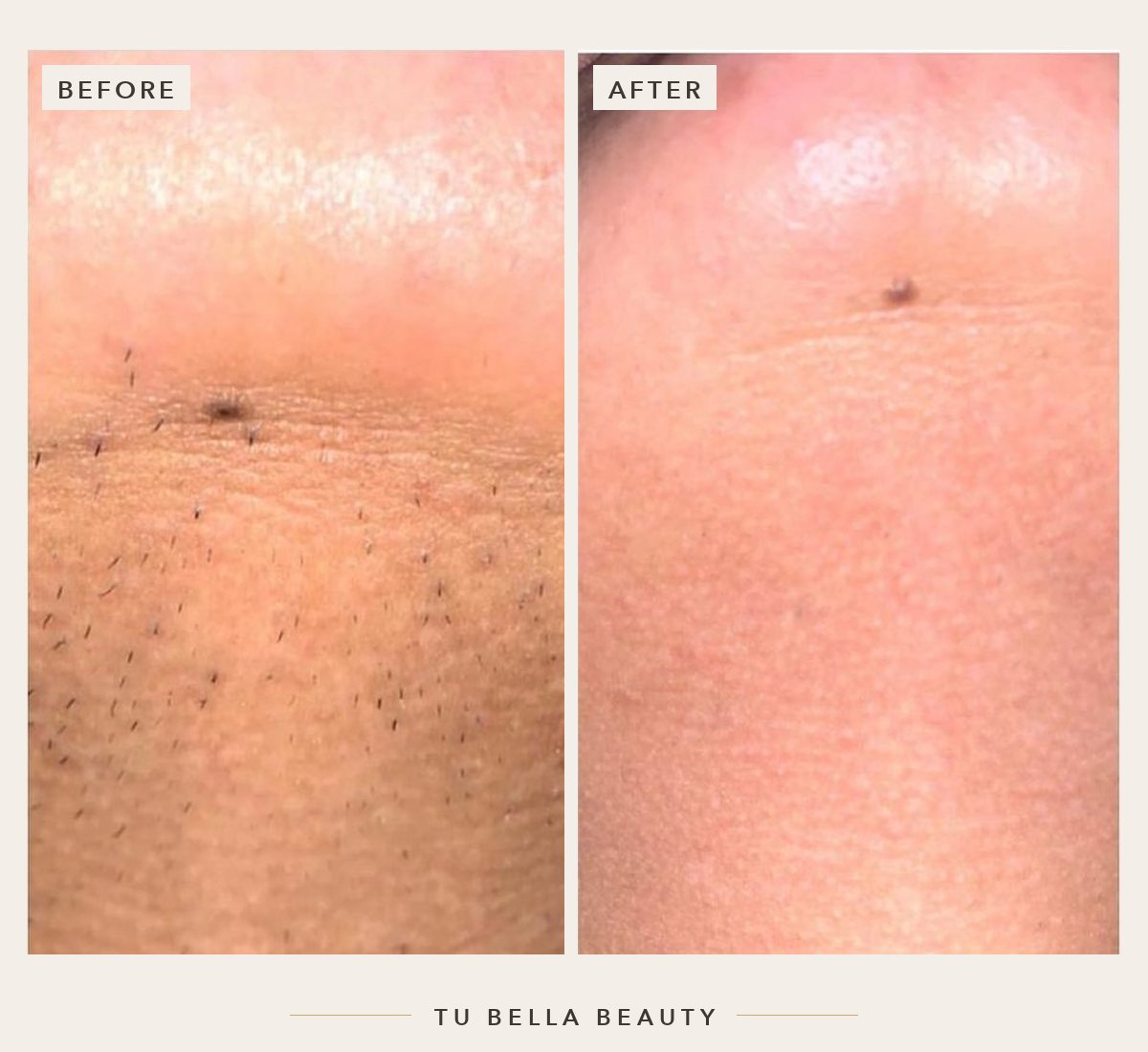 Laser hair removal before and after at Tu Bella, Hemel Hempstead: chin