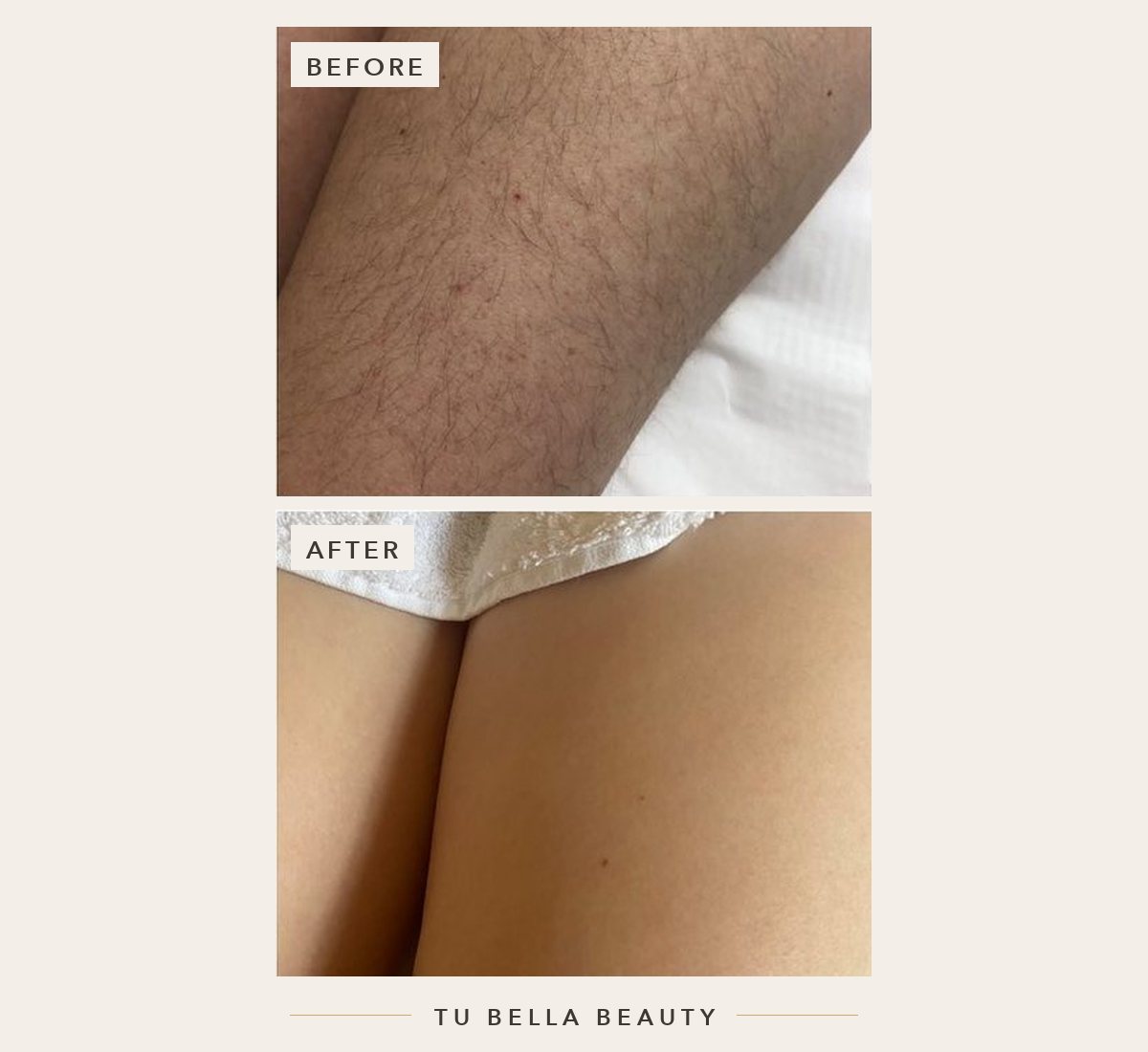 Laser hair removal before and after at Tu Bella, Hemel Hempstead: legs after a course of sessions