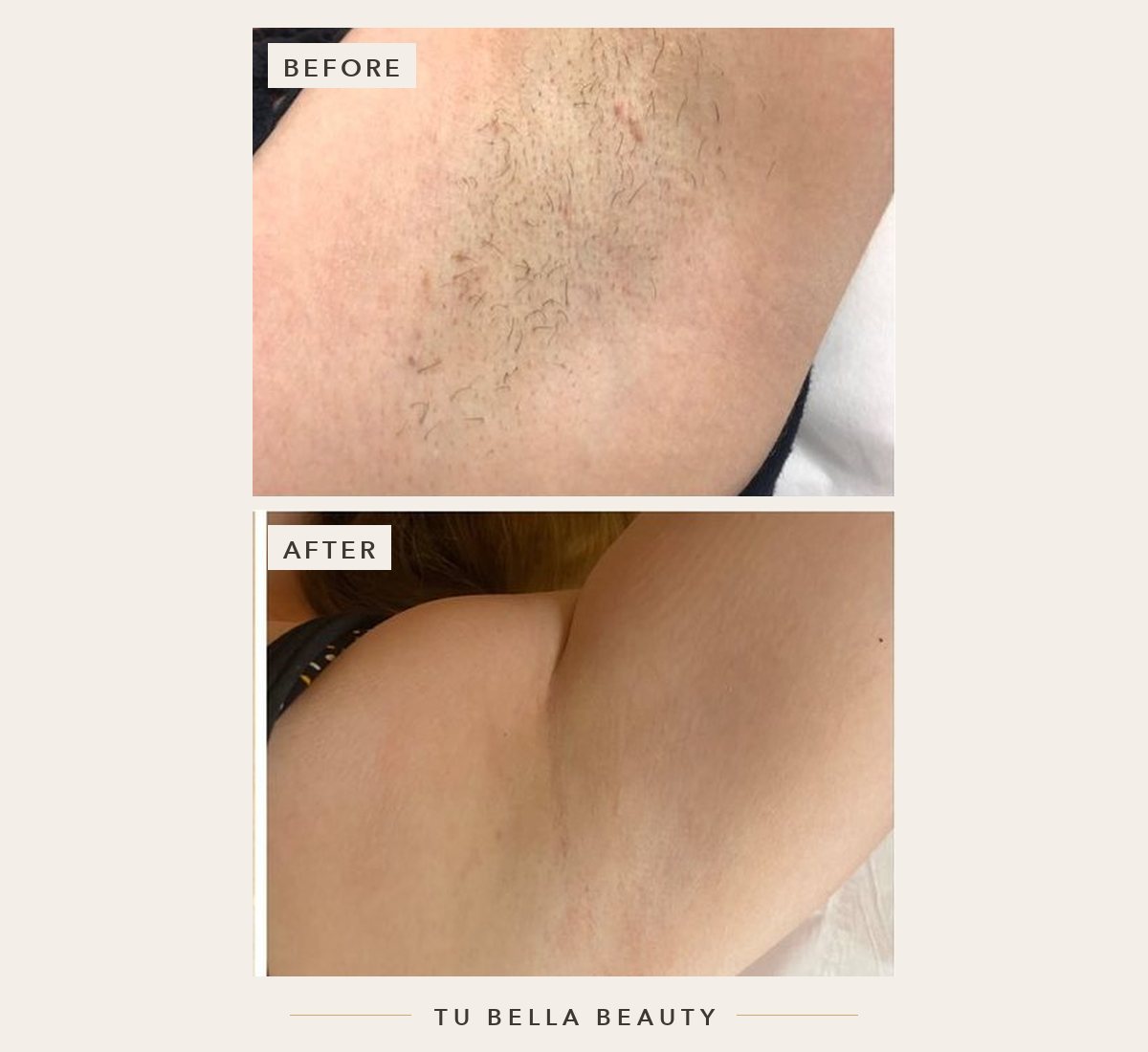 Laser hair removal before and after at Tu Bella, Hemel Hempstead: underarms after a course of sessions