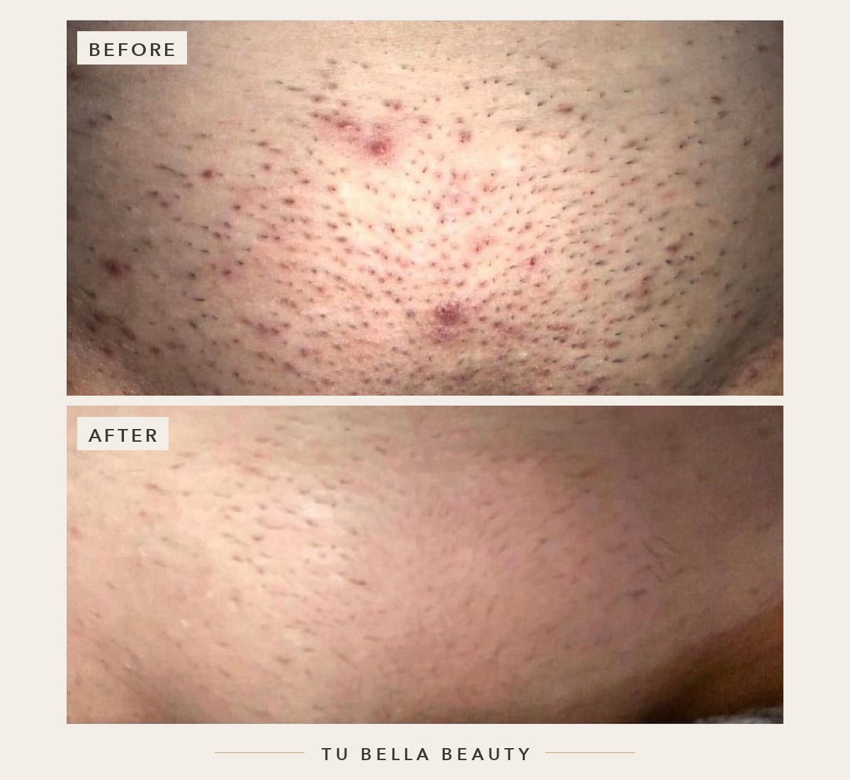 Laser hair removal before and after at Tu Bella, Hemel Hempstead: bikini line