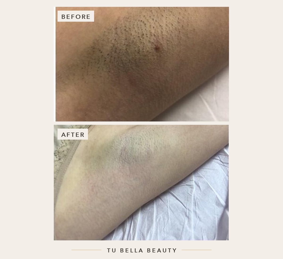 Laser hair removal before and after at Tu Bella, Hemel Hempstead: underarms after four sessions