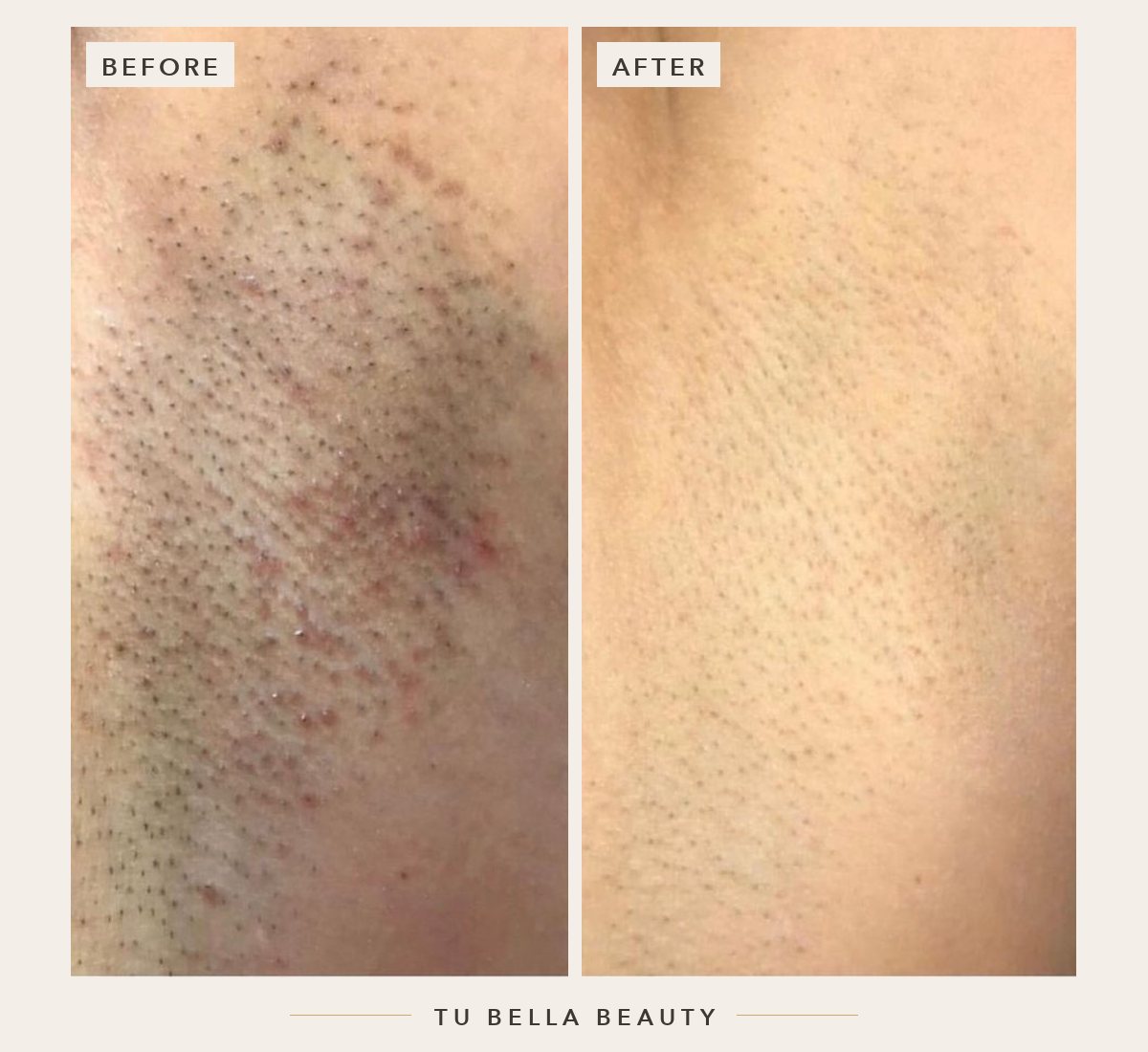 Laser hair removal before and after at Tu Bella, Hemel Hempstead: underarm